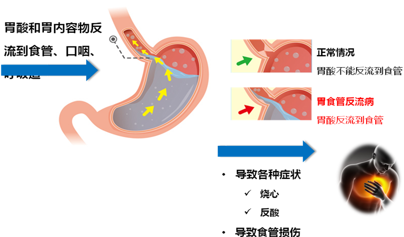 经常反酸水，来认识一下胃食管反流