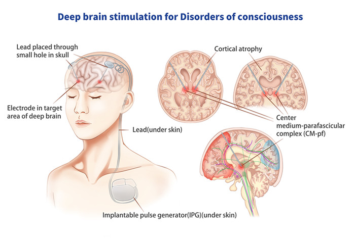 他们用10年研究证明 脑深部电刺激（DBS）可能对“植物人”有效！